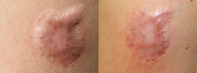 Before and After treatment images | Halina Spa in Round Rock & Austin, TX.