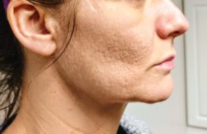 Before Scarlet treatment for skin lifting | Halina Spa in Round Rock & Austin, TX.