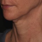 After Scarlet treatment on Neck | Halina Spa in Round Rock & Austin, TX.