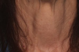 Before Scarlet treatment on Neck | Halina Spa in Round Rock & Austin, TX.