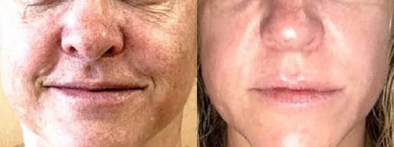 SKIN REJUVENATION SERVICES 53 Before and After treatment on face | Halina Spa in Round Rock & Austin, TX.