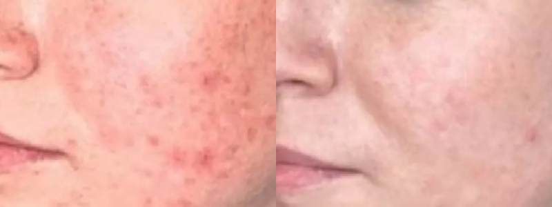 Before and After treatment on face | Halina Spa in Round Rock & Austin, TX.