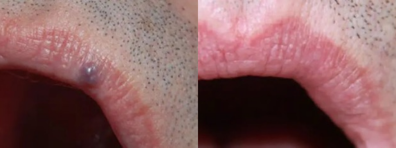 SKIN REJUVENATION SERVICES 63 Before and After treatment images | Halina Spa in Round Rock & Austin, TX.