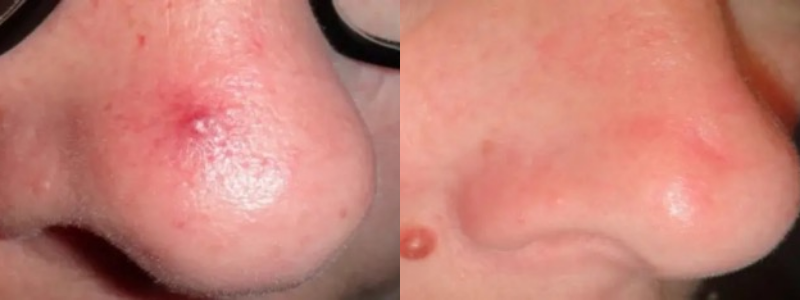 Before and After treatment images | Halina Spa in Round Rock & Austin, TX.