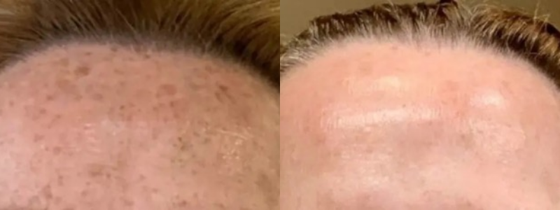 Before and After treatment on forehead | Halina Spa in Round Rock & Austin, TX.