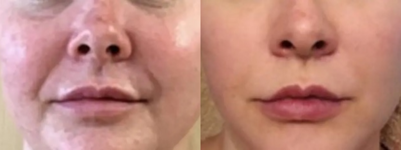 Before and After treatment on face | Halina Spa in Round Rock & Austin, TX.