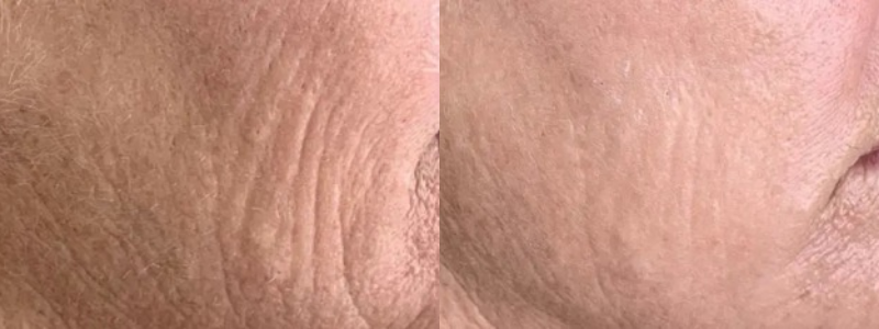 Before and After treatment on cheeks | Halina Spa in Round Rock & Austin, TX.