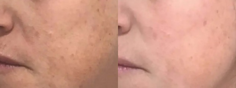 Before and After treatment on cheeks | Halina Spa in Round Rock & Austin, TX.