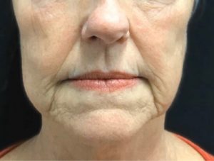 Before Scarlet treatment for Fine lines & Deep Wrinkles | Halina Spa in Round Rock & Austin, TX.