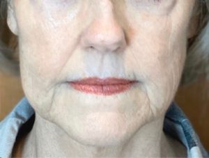 SKIN REJUVENATION SERVICES 4 After Scarlet treatment for Fine lines & Deep Wrinkles | Halina Spa in Round Rock & Austin, TX.