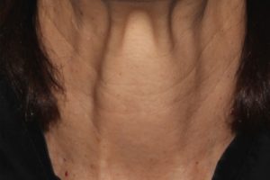 SKIN REJUVENATION SERVICES 17 After Scarlet treatment on Neck | Halina Spa in Round Rock & Austin, TX.
