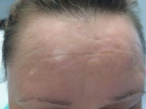 After Scarlet treatment for Forehead at Halina Spa in Round Rock & Austin, TX.