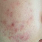 SKIN REJUVENATION SERVICES 27 Get Scarlet treatment for cheeks at Halina Spa in Round Rock & Austin, TX.