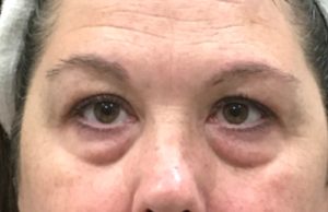 SKIN REJUVENATION SERVICES 29 After Agnes treatment at Halina Spa in Round Rock & Austin, TX.
