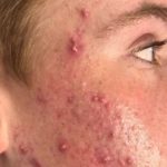 SKIN REJUVENATION SERVICES 43 Before Agnes treatment for acne at Halina Spa in Round Rock & Austin, TX.