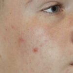 SKIN REJUVENATION SERVICES 44 After Agnes treatment for acne at Halina Spa in Round Rock & Austin, TX.